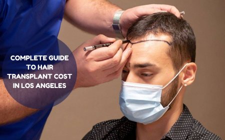 Complete Guide to Hair Transplant Cost in Los Angeles