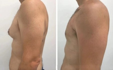 The Best Surgeons for Gynecomastia in Dubai: Why Experience Matters
