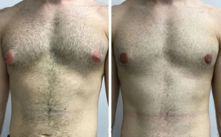 Traveling for Surgery? What to Know About the Best Gynecomastia Surgeons in Dubai