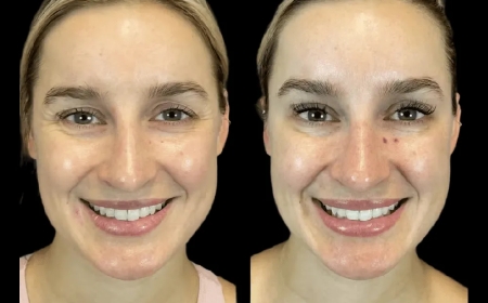 What to Expect During Your Botox Appointment with the Best Plastic Surgeon in dubai