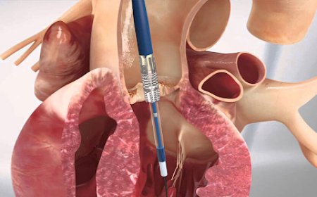 When the Heart Has No Other Alternative: Understanding Valve Replacement Open Heart Surgery