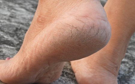 Get Footcare Help for Corns, Cracks, and Pain in Edinburgh Clinic