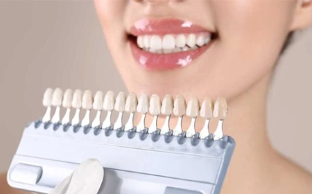 Best Veneers in Pakistan – Dental Aesthetics Lahore