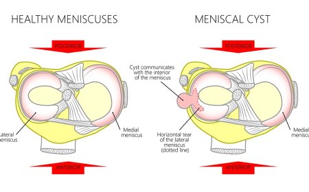 What You Need To Know About Meniscal Cyst?