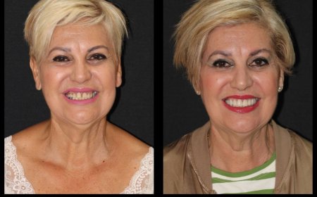 Estética Dental en Hospitalet de Llobregat Transforma tu Sonrisa