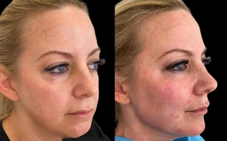 How Safe Are Cheek Fillers Treatments in Dubai?