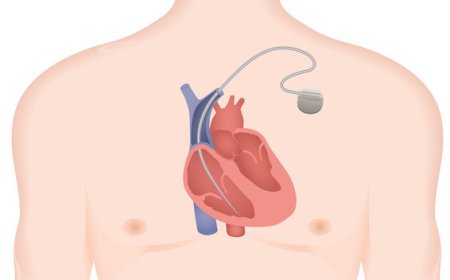 Implantable Cardiac Monitors Market : Size, Trends, and Growth Forecast to 2032