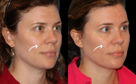 Are Sculptra Fillers Treatments in Dubai FDA Approved?