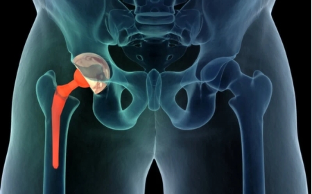 Hip Replacement vs. Hip Resurfacing: Which One Is Right for You?