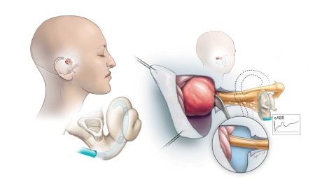 Acoustic Neuroma Market Size, Trends, and Strategic Insights 2025-2032