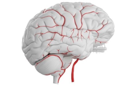 Vascular Dementia Market Size, Trends, and Growth Opportunities 2025-2032