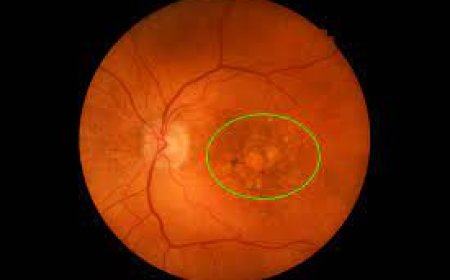 Intermediate AMD Market Size, Trends, and Growth Forecast 2025-2032