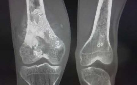 Osteosarcoma Treatment Market: Size, Trends, and Growth Analysis 2025-2032