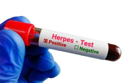HSV Test: What It Is, When You Need It, and How It Helps Detect Herpes Infection