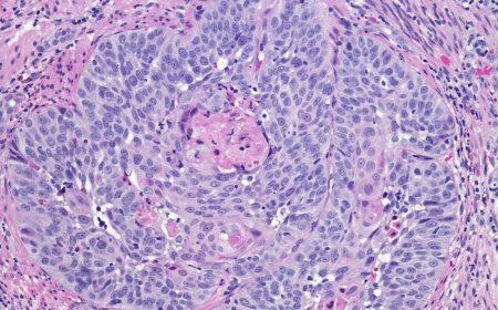 Advanced Non-Squamous and Squamous NSCLC Market Growth and Dynamics: 2025-2032
