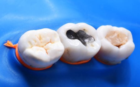Is the Cavity Filling Cost Worth It? A Look at Long-Term Dental Health