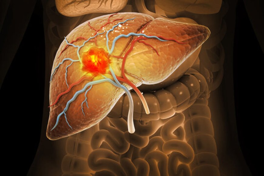 Advanced Liver Cancer Market Size, Trends, and Growth Opportunities (2025-2032)