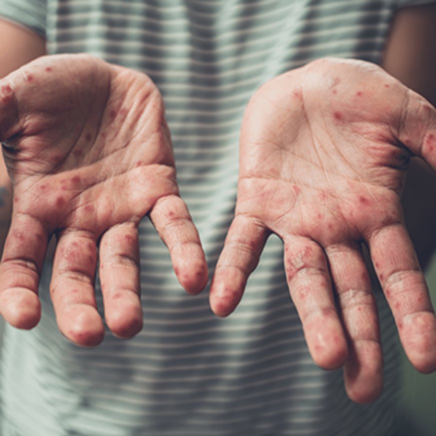 Hand Foot Syndrome Market Size, Trends, and Growth Forecast 2025-2032